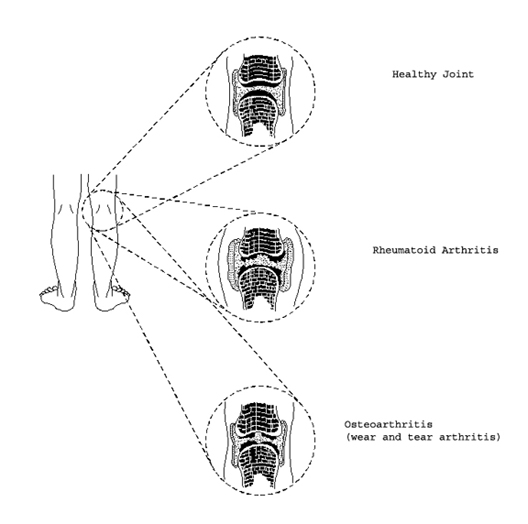 Healthy joint, rheumatoid arthritis, osteoarthritis